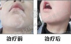7歲兒童挑食遇見“白癜風”