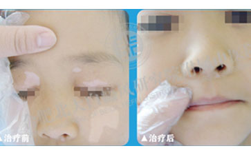 袪“白”成功，還孩子一個(gè)快樂(lè)的童年