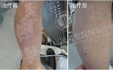 可怕的白癜風(fēng)，差點(diǎn)讓我失去生命