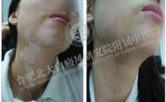 白癜風拜拜，重新生活