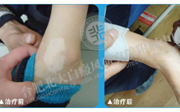 白癜風(fēng)，我終于徹底擺脫你