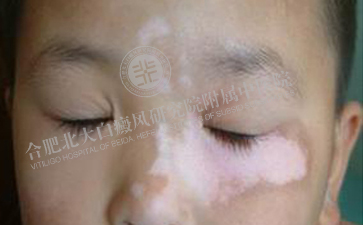 與白癜風(fēng)說(shuō)拜拜，重新恢復(fù)燦爛笑容