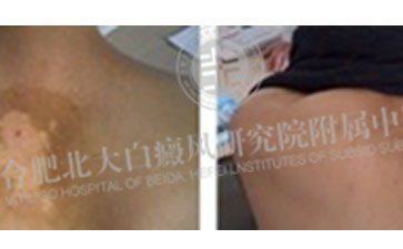 治愈白癜風 告別單身生活