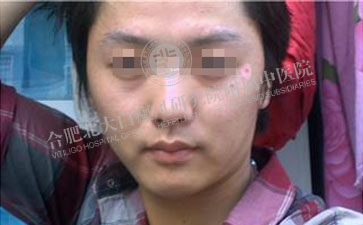 告別白癜風(fēng)，輕松面對(duì)高考